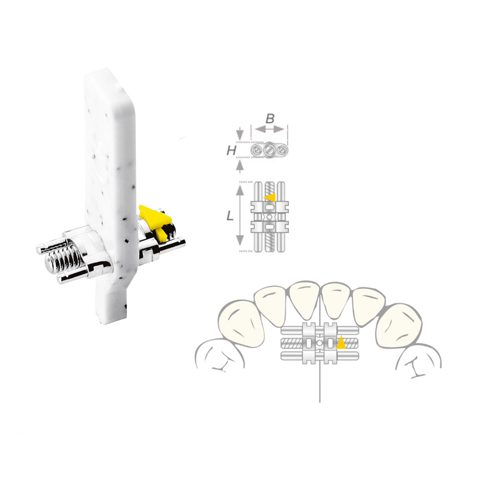 Vector 50 Dehnschraube Micro, 50 Stück