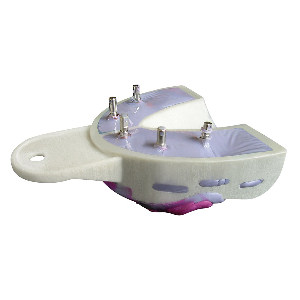 Miratray Implant Abdrucklöffel UK I2, 6 Stück Set